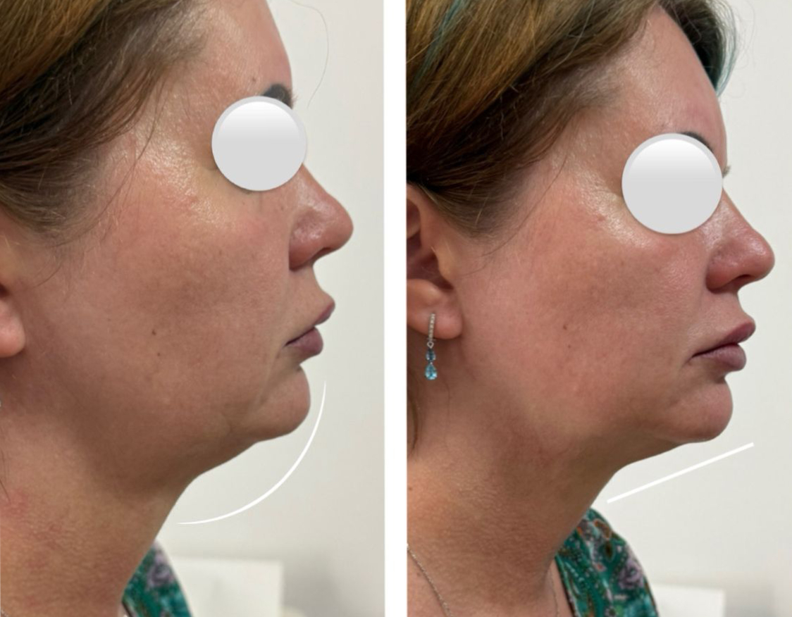 HIFU Facial – contur mandibular