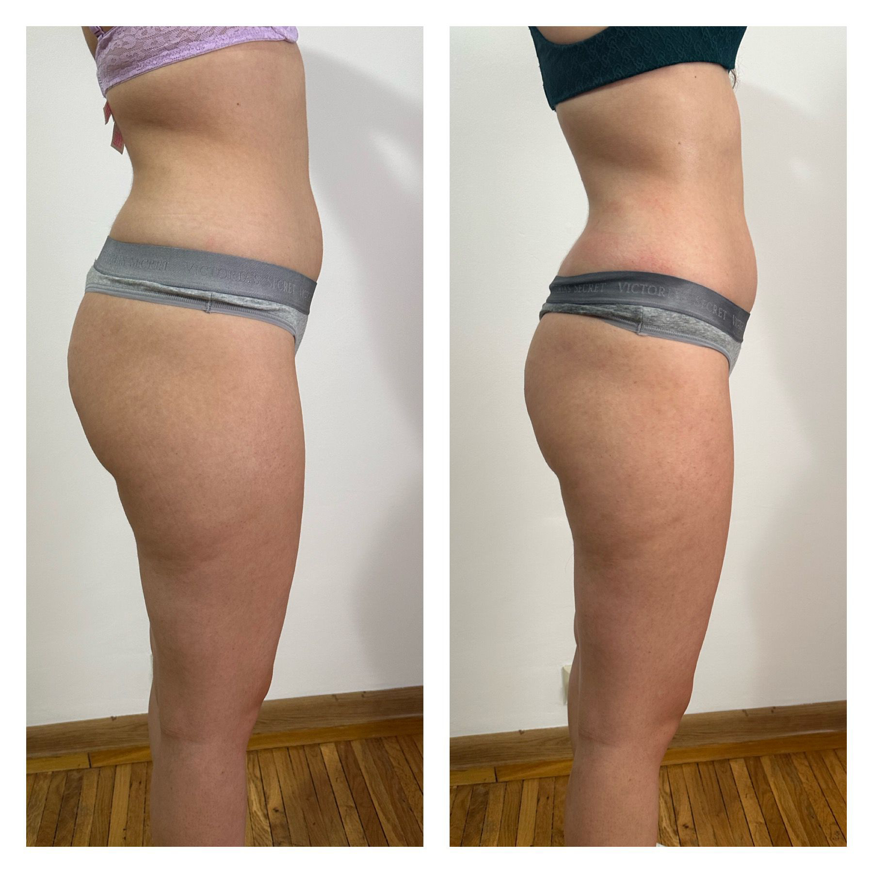 Remodelare – abdomen si fese