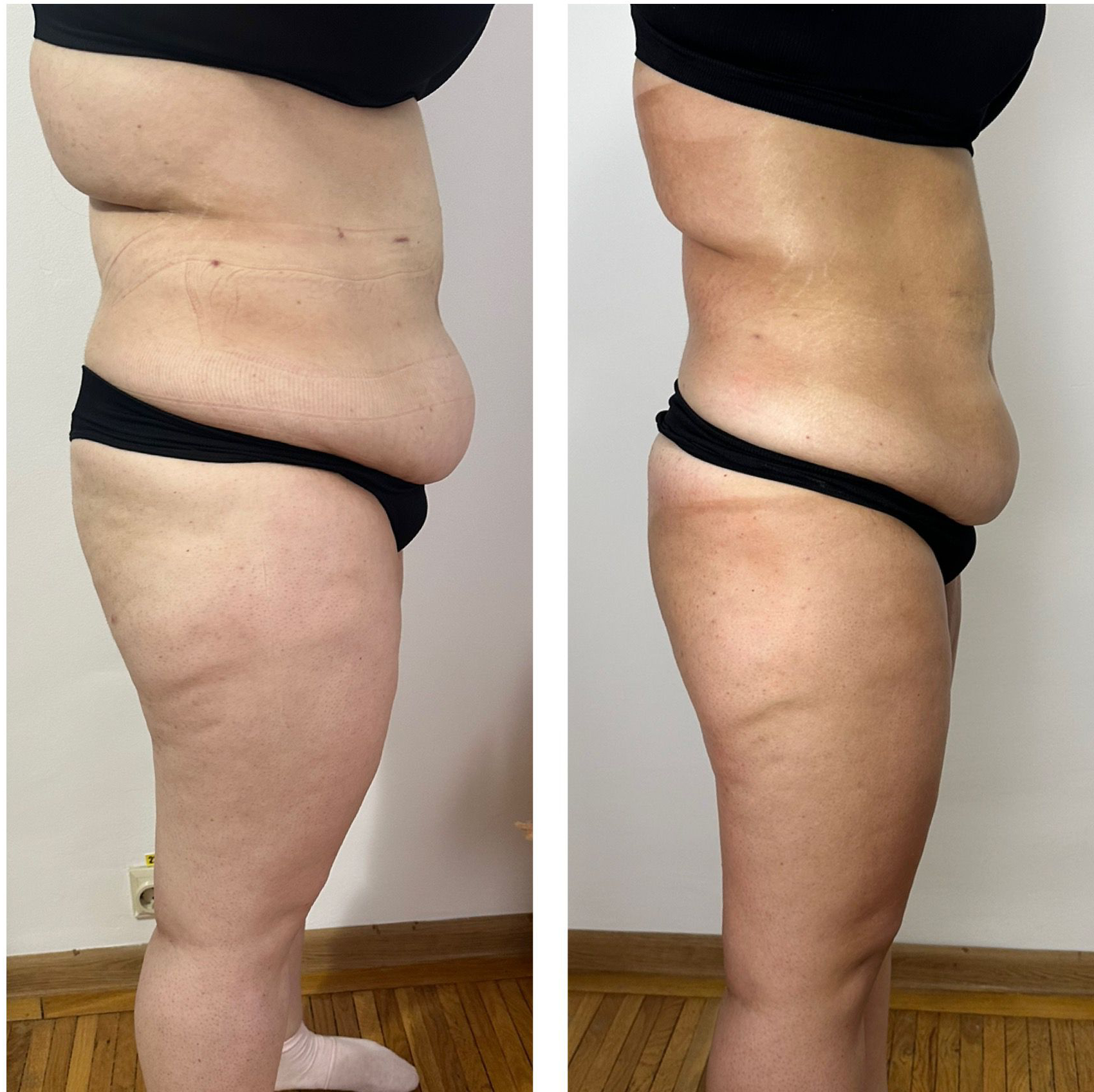 Remodelare – abdomen lateral