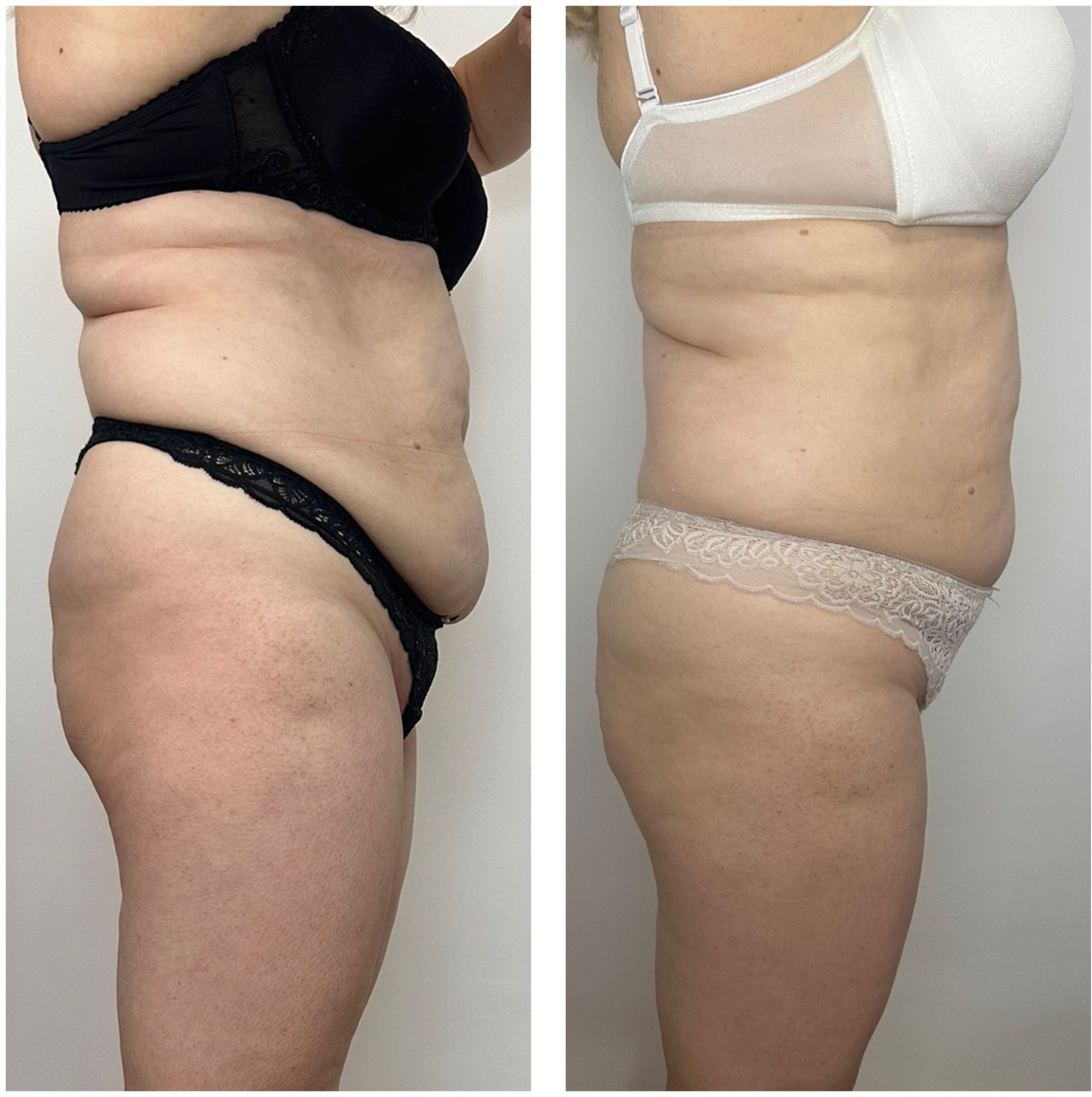 Remodelare – transformare abdomen